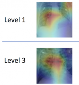 Xray of pulmonary edema